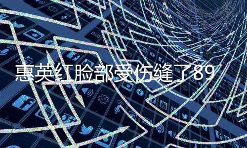 惠英紅臉部受傷縫了89針，經(jīng)歷令人震驚