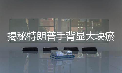 揭秘特朗普手背顯大塊瘀傷背后的故事，白宮官方解釋與爭議