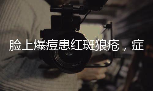 臉上爆痘患紅斑狼瘡，癥狀解析與應(yīng)對之道